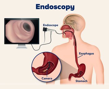 Endoscopy in Basavanagudi: When Do You Need It and What to Expect – Gut ...